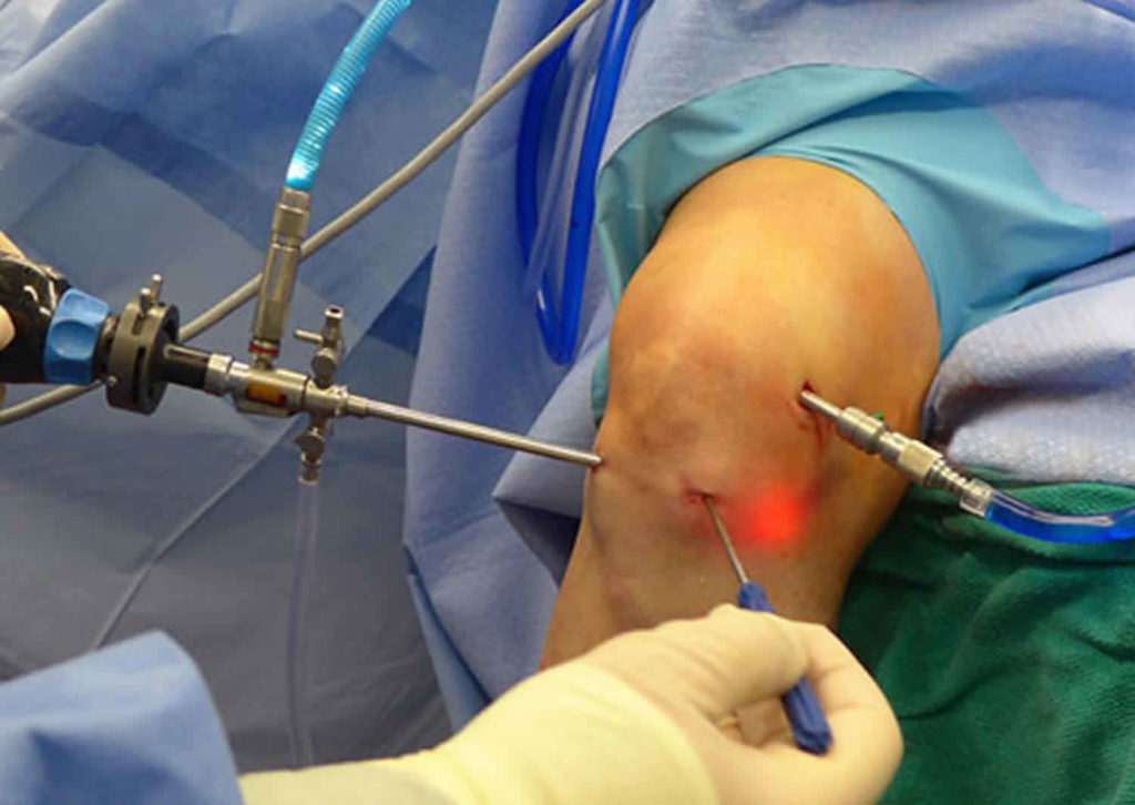 Jak dlouho bolí koleno po artroskopii?