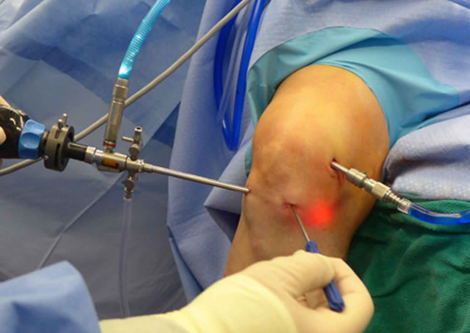 Kdy je nutna artroskopie kolene?